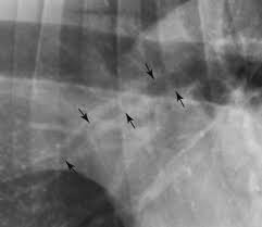 Image result for Air Bronchogram