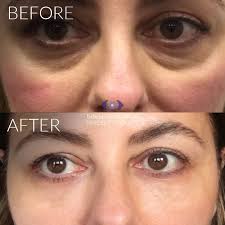 There is no definitive answer. Tear Trough Fillers A Solution To Dark Circles Eye Bags Hollows