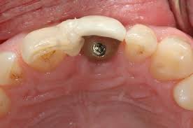 How to fix a broken front tooth the same day! Managing Patients With A Loose Implant Abutment Screw Jcda
