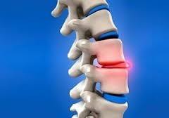 Hernia de disc lombara reprezintă cauza cea mai frecventă a sindromului lomboradicular. Hernia De Disc De Ce PersistÄ Durerile DupÄ OperaÅ£ie