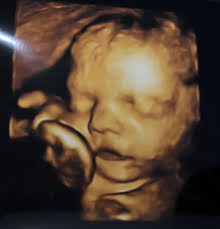 Miracles Happen 3D/4D/HD Ultrasound