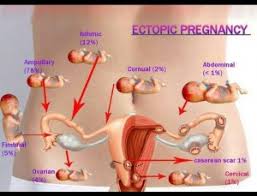 ectopic pregnancy คือ 2