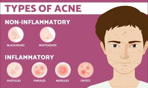 Fat necrosis can look like cancer on a mammogram, so a core biopsy is usually taken. Acne Know Causes Symptoms Risks And The Best Treatment Blog Care Well Medical Centre