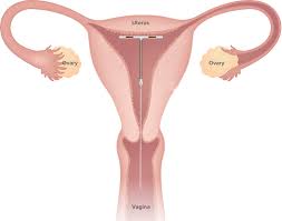 Rare cancerous or noncancerous liver tumors; Paragard Iud Birth Control Device The Olinde Firm New Orleans Attorneys