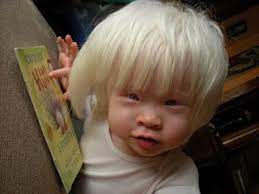 Stress does cause hair to go white, but not much. Pin By Mellissa Davis On Albinism Adoption Blogs Albino Human Beautiful Albino Albinism