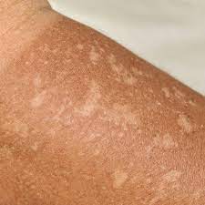 Glibenclamide dapat membuat anda lebih sensitif terhadap sinar matahari. Apa Beda Reaksi Alergi Sinar Matahari Dan Kulit Terbakar Matahari