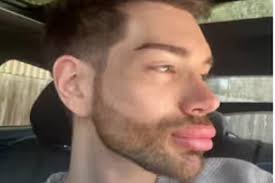 Żywy Ken' pokazał się po operacji powiek i usunięciu wypełniaczy. 'Wygląda  o wiele lepiej'