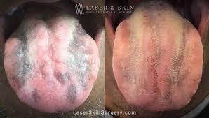 Image result for black tongue symptoms