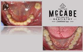 2 Bridges Dental Missing Teeth Prevention