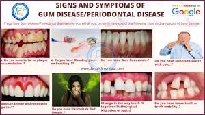Are the most common symptoms of gingivitis. Pyria Pyorrhea In Teeth Meaning 8 Signs Symptoms Diagnosis Treatment Prestige Dental Care