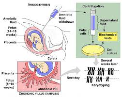 Amniocentesis Vs Chorionic Villus Sampling Nursing School Studying School Study Tips Obstetrics