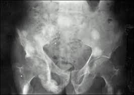 Paget S Disease Of Bone Endotext Ncbi Bookshelf