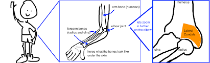 Image result for Lateral Condyle Fracture
