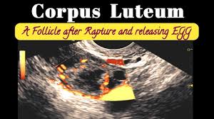 Image result for corpus luteum sonography)