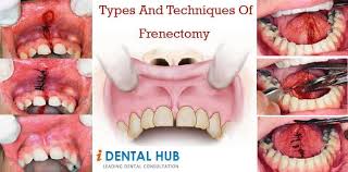 Types And Techniques Of Frenectomy Dental Dentistry Dental Care