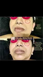 Do you have unsightly #moles . #skintags , #hyperpigmentation ? I can  help!!! Look at these photos!! These are taken today before and immediately  following #treatment ! (Of course as w/ any procedure ...