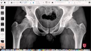 ●to review pelvic sidewall anatomy including retroperitoneal spaces. Pelvis And Hips Essential Radiography Re Post Youtube