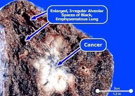 While the primary cause of lung cancer is tobacco smoking, which accounts for up to 80% of cases, the disease can also occur as a consequence of asbestos exposure in occupational or. Asbestos Cancer Mesothelioma In Lungs Mesothelioma Treatment Centers Org