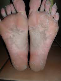 Any feet calluses that you may have had will be gone along with the dead skin that sheds off. Dead Skin Acid Peel For Your Feet Kitchen Cabinet Remedy