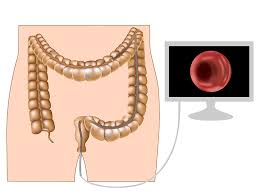 Clicca qui per scoprire scoprire di più scopri di piu'. Cancerul Colorectal Vindecat Rapid Prin Depistare Precoce Reginamaria Ro