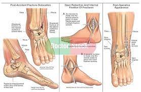 Exactly What Happened To Me Broken Ankle Recovery Ankle Fracture Ankle Surgery Recovery