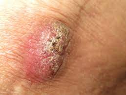 Suture granuloma occurs when the human body judges sutures and surgical materials to be a threat to itself. Foreign Body Granuloma Dermnet Nz