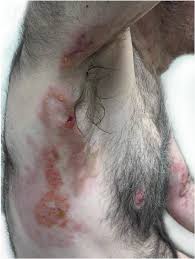 Educational image placeholder: neuropathy and skin vasculitis in EGPA