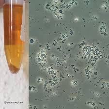 Thick Sediment With Amorphous Urates In A Patient With Aki Phase Contrast X400 Urinarysedi Medical Laboratory Medical Laboratory Science Laboratory Science