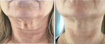 There are many ways to treat and get rid of crepey skin in case you already suffer from it. My Crepey Skin Remedies Natural Treatments To Help Get Rid Of Crepey Skin Health Facts Journal Crepey Skin Natural Skin Care Sagging Skin