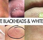 HOW TO REMOVE BLACKHEADS & WHITEHEADS | Natural Coffee Scrub for clogged pores