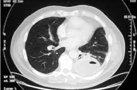 Ct Scan Of The Chest Showing Scarring At The Base Of Left Lower Lobe Download Scientific Diagram