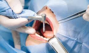 What You Need To Know About Dental Implant Surgery