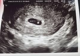 We've partnered with the american institute of ultrasound medicine (aium), johns hopkins, and the march of dimes to create this unique peak into baby's development inside the womb. 6 Week Ultrasound November 2018 Babies Forums What To Expect