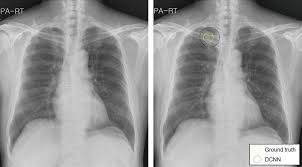 Image result for lung cancer xray