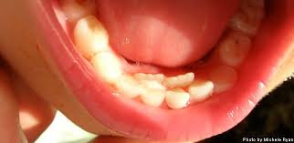 Shark Teeth Permanent Teeth Coming In Behind Baby Teeth Just Noticed Today That My Juliet Has A Permanent T Shark Teeth Taking Teeth Out Kids Dental Health