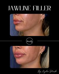 Kylie Thomson (Stark), RN, BSN (@kylie.stark_aesthetic_rn) • Instagram  photos and videos