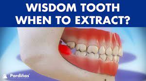 They are located at the back of upper and lower jaws and are the last teeth to emerge in the oral cavity. Wisdom Teeth Removal And Pericoronaritis C Youtube