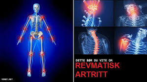 Behandling av reumatoid artritt hos ungdom. Revmatisk Artritt Arsak Diagnose Symptomer Og Behandling