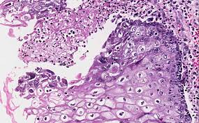 Looking to download safe free latest software now. Case No A 007 Diagnosis Herpes Esophagitis Organ Esophagus Last Updated 1 21 2011 Online Slide Full Screen Open With Imagescope Hematoxylin Eosin Area 1 Note That The Ulcer Is Rimmed By Intact Mucosa The Ulcer Is Covered By A Thin Layer Of