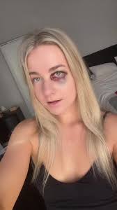 😅😆 #bruisefromfalling #blackeye #tiktoksouthafrica #fyp