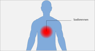 Speiserohrenentzundung Osophagitis Refluxosophagitis