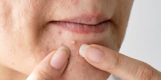 Just Try And Tear Your Eyes Away In 2020 Pimple Popping Acne Poping Pimples