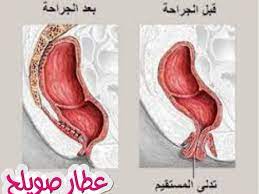 ألف شريك فوق الرأس والكتف هبوط المستقيم عند النساء dsvdedommel com