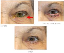 Image result for Entropion