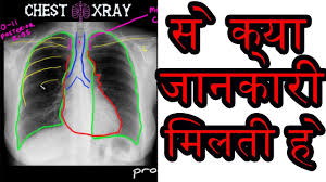 Chest X Ray Reading In Hindi Chest X Ray Results Explained Medical Guruji Youtube