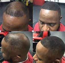 However, it can be some hair transplant surgeons believe this procedure is well suited to african american hair because of the added challenges of harvesting hair follicles. Black Man Hair Loss Novocom Top