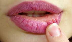 Remember not to directly apply ice on your swollen lip because it can result in mild frostbite or soreness. What Are Swollen Lips Causes And Treatment Infographic Sure Dental