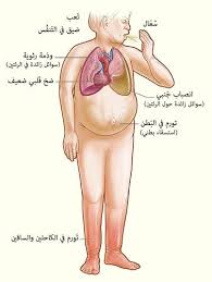فشل عضلة القلب قصور عضلة القلب فشل عضلة القلب heart failure هو عدم قدرة القلب على القيام بضخ الدم الى انحاء الجسم على اكمل وجة ا blog posts health blog