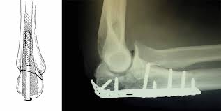 Elbow Olecranon Fractures Orthoinfo Aaos