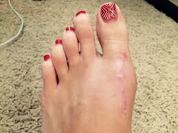 Week 7 And 8 Bunion Surgery Foot Surgery Recovery Foot Surgery